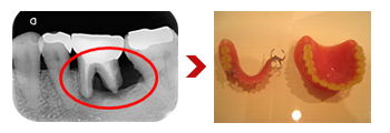 歯周病のレントゲン画像